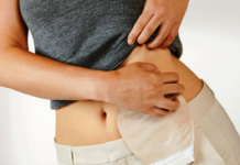 Pacientes com ostomia podem ter vida normal, afirma Coloproctologista Mardem Machado